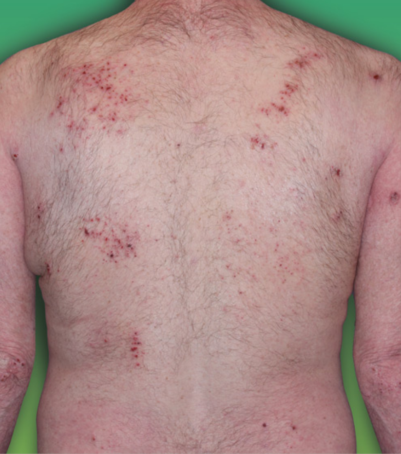 Dermatite atopique sévère (IGA 4), observée chez 48 % des patients au départ. 