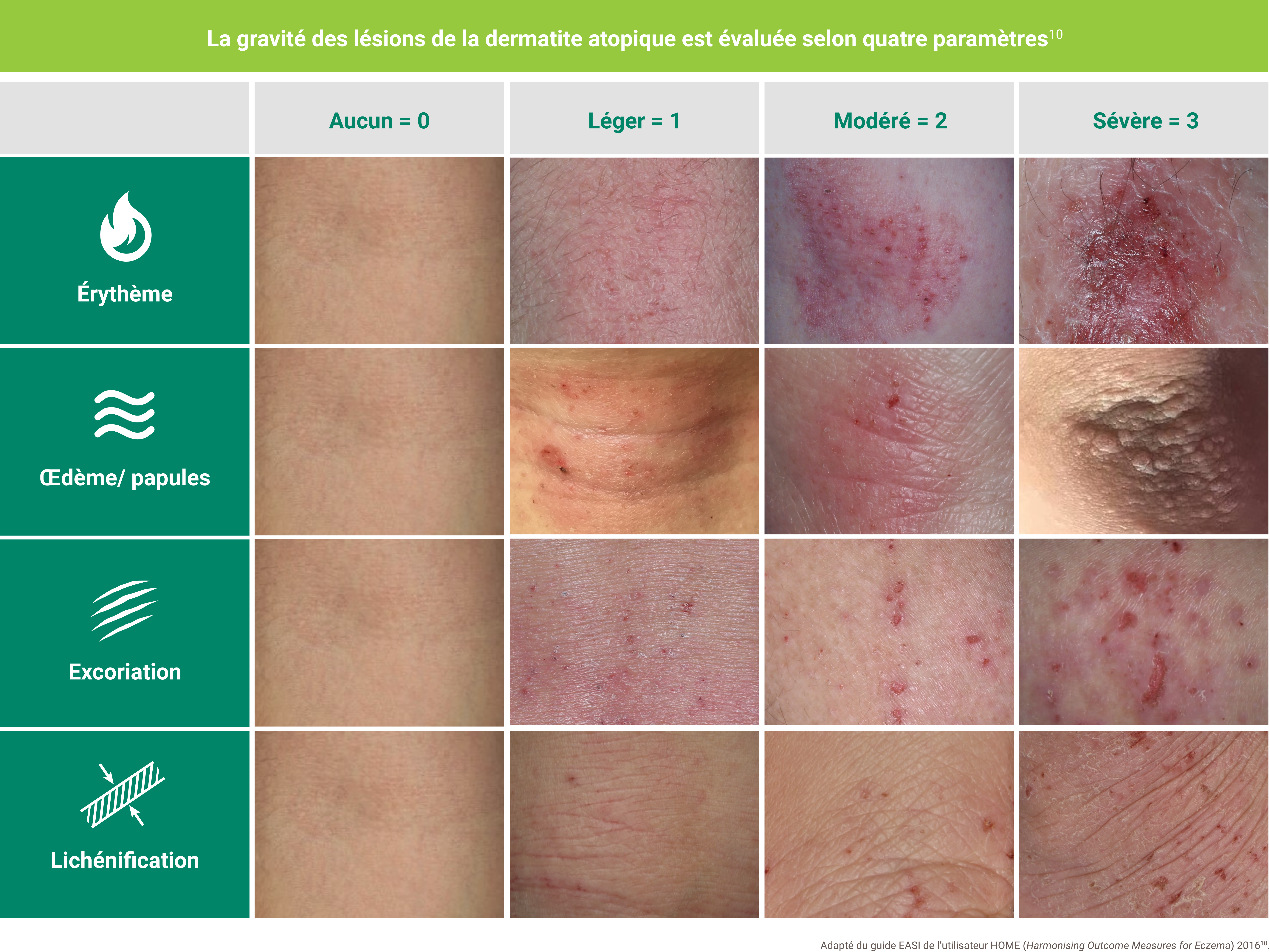 Photos montrant comment les quatre paramètres du score EASI sont évalués. Les patients peuvent recevoir un score de 0 à 3 pour chacun des quatre paramètres : érythème, œdème/papules, excoriation et lichénification, où un score de 0 indique que le paramètre est absent, un score de 1 indique que le paramètre est léger, un score de 2 indique que le paramètre est modéré et un score de 3 indique que le paramètre est sévère. Les patients reçoivent un score de 1 pour un érythème à peine détectable et rose, un œdème et des papules où l’augmentation est à peine perceptible, une excoriation minime et superficielle et une lichénification avec léger épaississement de la peau et des marques peu exagérées. Les patients reçoivent un score de 2 pour un érythème rouge terne facilement perceptible, un œdème ou des papules avec augmentation clairement perceptible mais non proéminente, beaucoup d’excoriations superficielles et/ou quelques excoriations profondes et une lichénification si la peau est épaissie avec des marques exagérées et/ou certains nodules prurigineux. Les patients reçoivent un score de 3 pour un érythème rouge foncé profond ou rouge vif ardent, un œdème ou des papules avec augmentation proéminente, des excoriations superficielles étendues et/ou des excoriations profondes et une lichénification, s’ils ont des marques exagérées créant des sillons profonds et/ou de nombreux nodules prurigineux.